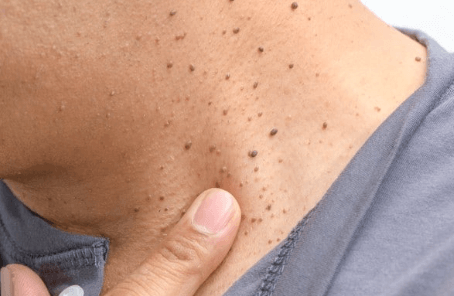 Pictures Of Skin Tags